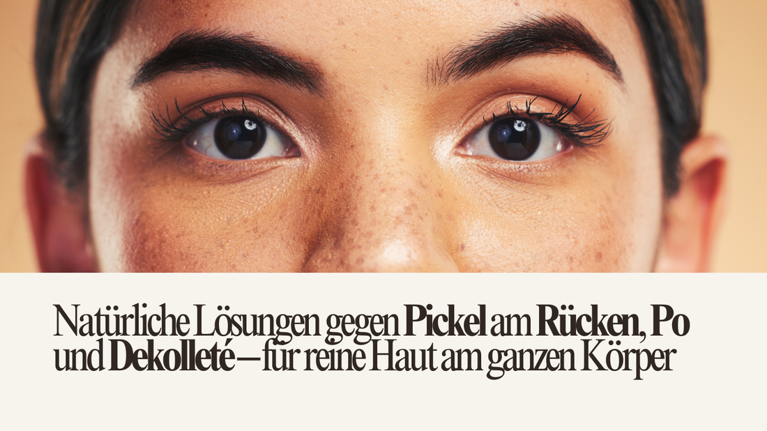Nahaufnahme einer Frau mit Hautunreinheiten im Gesicht – Symbolbild für Pickel am Rücken, Po und Dekolleté. Natürlich schön mit natürlicher Hautpflege.