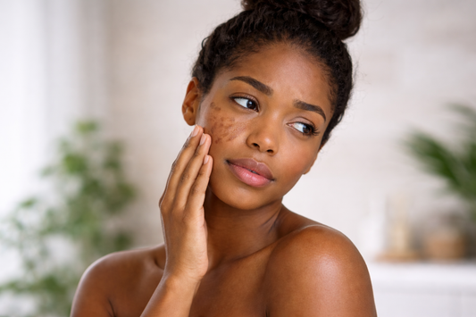 Frau mit dunkler Haut und Dutt berührt nachdenklich ihre Wange mit sichtbaren Melasma-Flecken, die typisch für hartnäckige Hyperpigmentierung bei melaninreicher Haut sind.