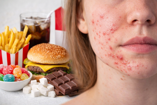 Pickel und Hautunreinheiten durch falsche Ernährung mit Zucker, Fast Food und stark verarbeiteten Lebensmitteln